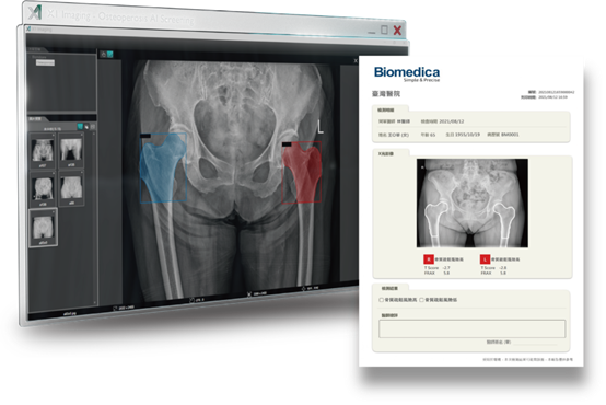 骨質疏鬆是全世界第二大流行病，本文將介紹如何使用一般X光機或行動X光車拍攝出符合WHO醫學指引的髖部醫學影像，並運用AI輔助分析，於6秒鐘內產出骨質疏鬆風險報告。